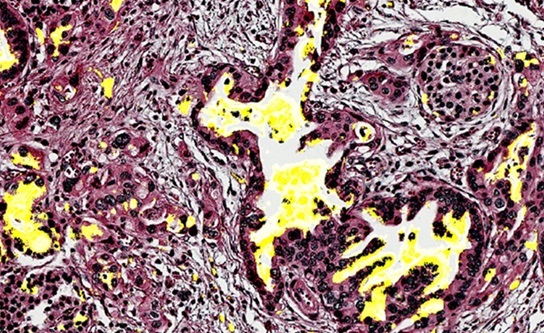 Imagen: tejido pancreático con el biomarcador CA199.STRA en amarillo (Foto cortesía de Haab Lab/Van Andel Institute)